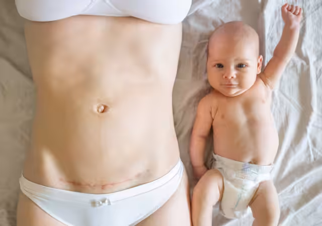 J'accouche par césarienne : les conseils pour me préparer